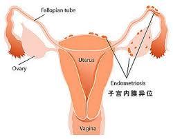 子宫内膜异位症2.jpg